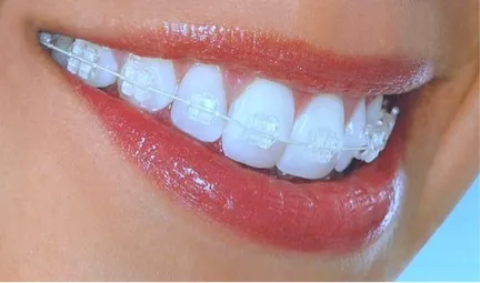 Ceramic Braces